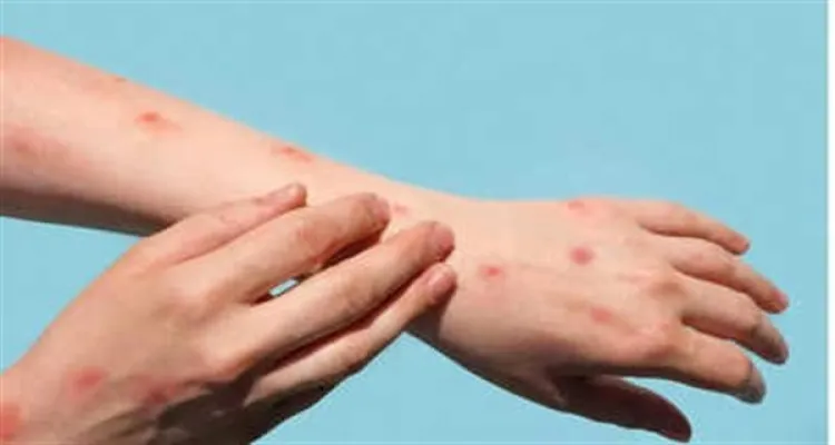 ظهور حالات جدري داخل مدرسة ابتدائية في المنوفية