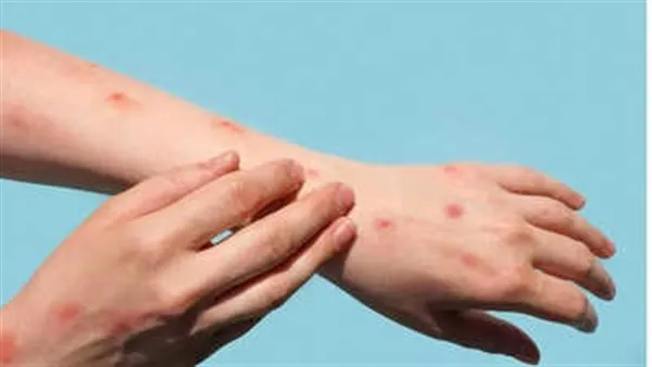 ظهور حالات جدري داخل مدرسة ابتدائية في المنوفية